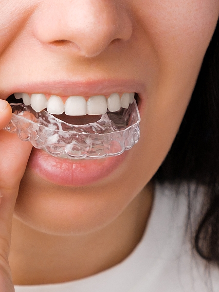 Şeffaf Plak Tedavisi Uygulamaları